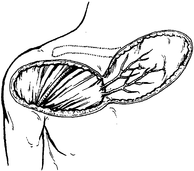 3 胸三角皮瓣